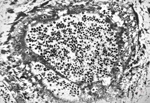 poxvirus - molluscum contagiosum